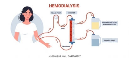 hemodialysis-kidney-treatment-infographics-woman-260nw-1647368767.jpg